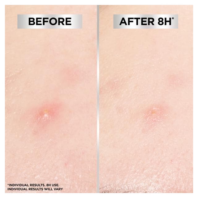 Garnier 8H Invisible Blemish Patches for Spots x44 - gallery image 5